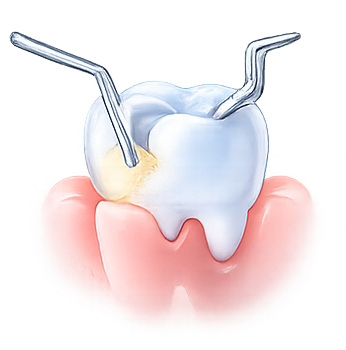 Subgingivální ošetření